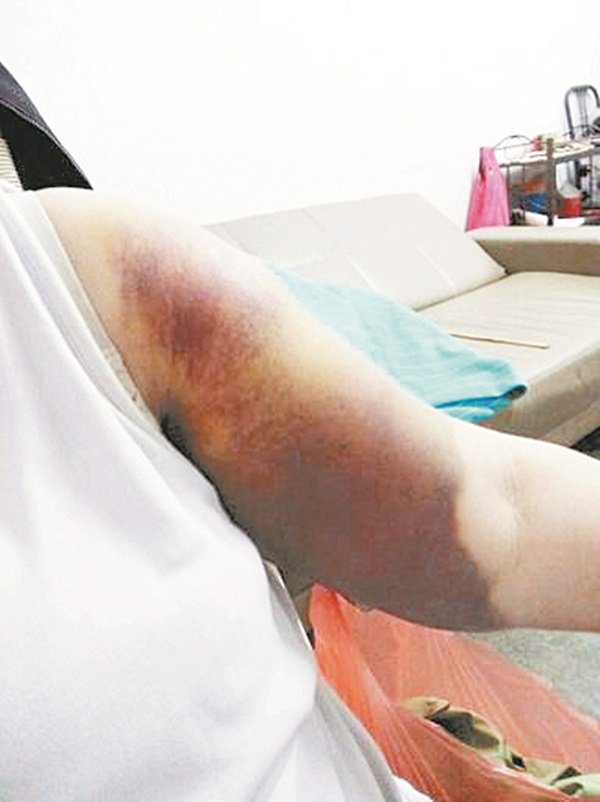 洪陈丽珠遭持铁棍劫匪打至重伤，左手臂因淤伤而肿痛。