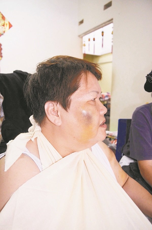 洪陈丽珠的右脸因淤伤而肿痛。