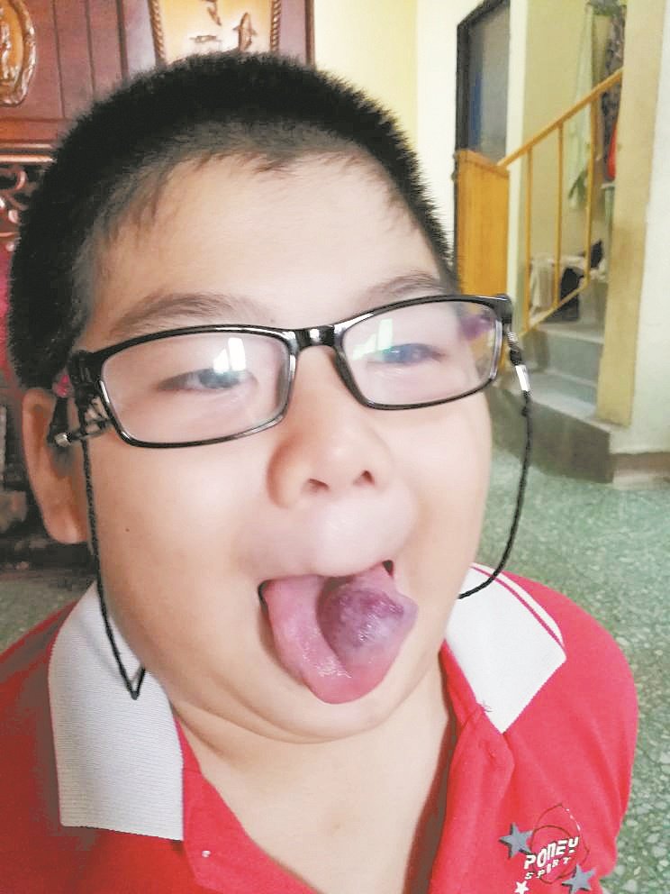 患先天性舌头血管瘤的儿子，2年里3度刺破舌头，治疗刻不容缓。