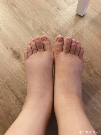 熊黛林的双脚严重肿胀。