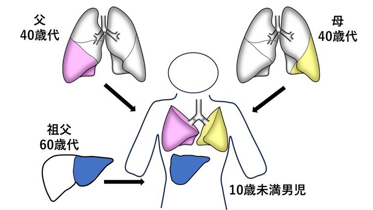 男童同时接受双亲及祖父所捐出的部分肺与肝移植。（图取自京都大学医院）