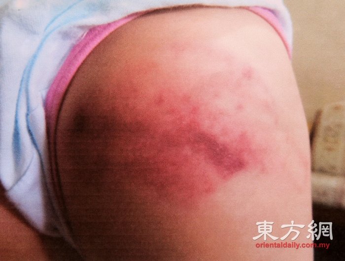 学生被鞭打的部位，伤口严重红肿及出现瘀血 。 （摄影：刘维杰）