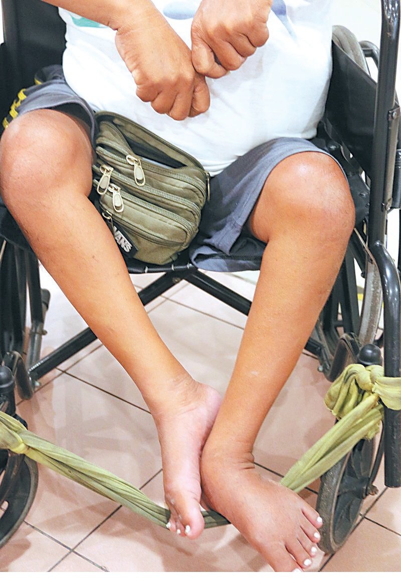 从小被诊断患上小儿麻痹症的吴国祥双脚已经萎缩，无法正常行走。
