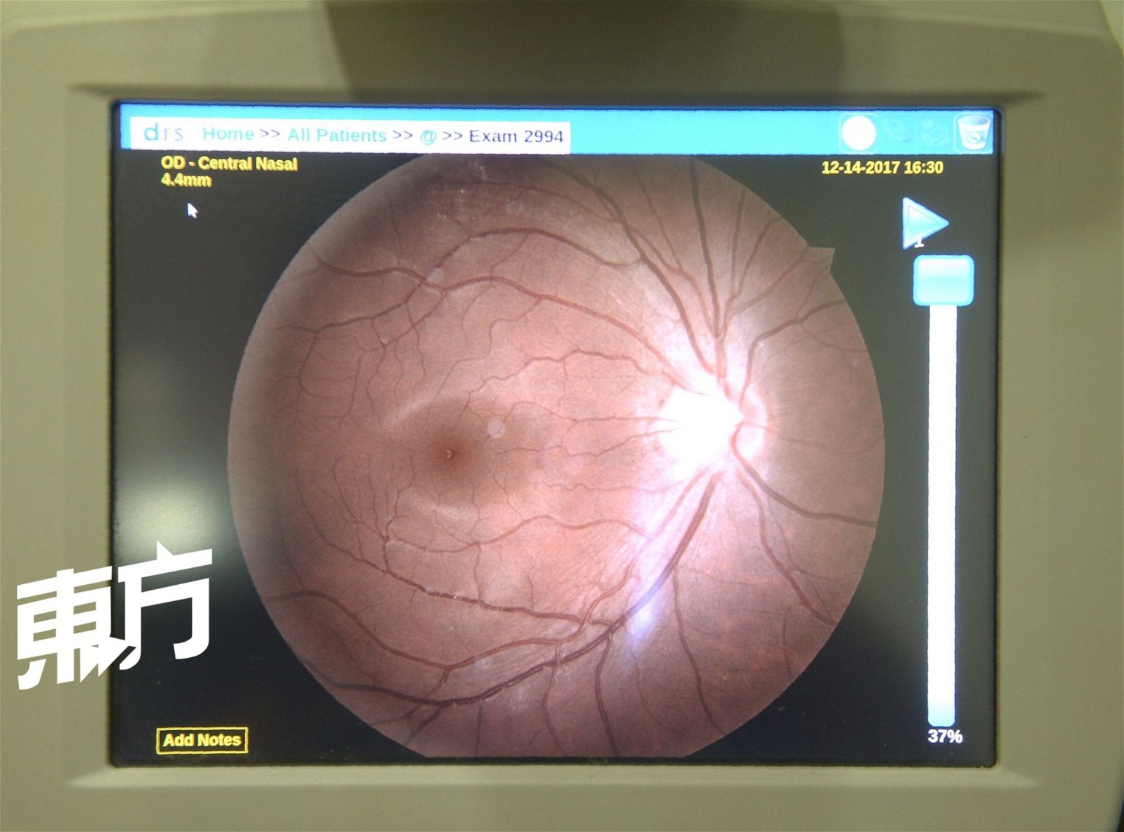 图为眼球后方扫瞄图，眼科视光师可依照图片的阴影及光圈判断顾客是否有近视、青光眼等症状。