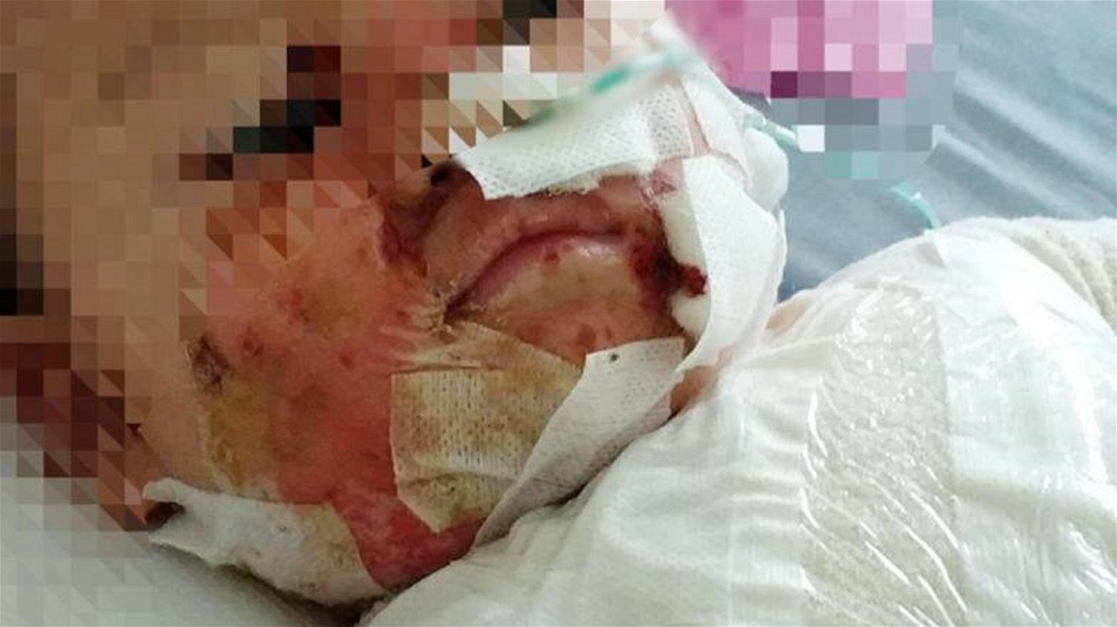 1岁4个月大男婴被滚烫的热水烫伤身体40%部位，目前留医竹脚妇幼医院治疗。