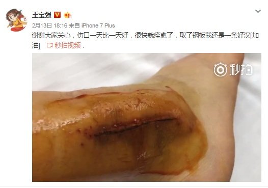 王宝强上载伤口恢复状况的照片。
