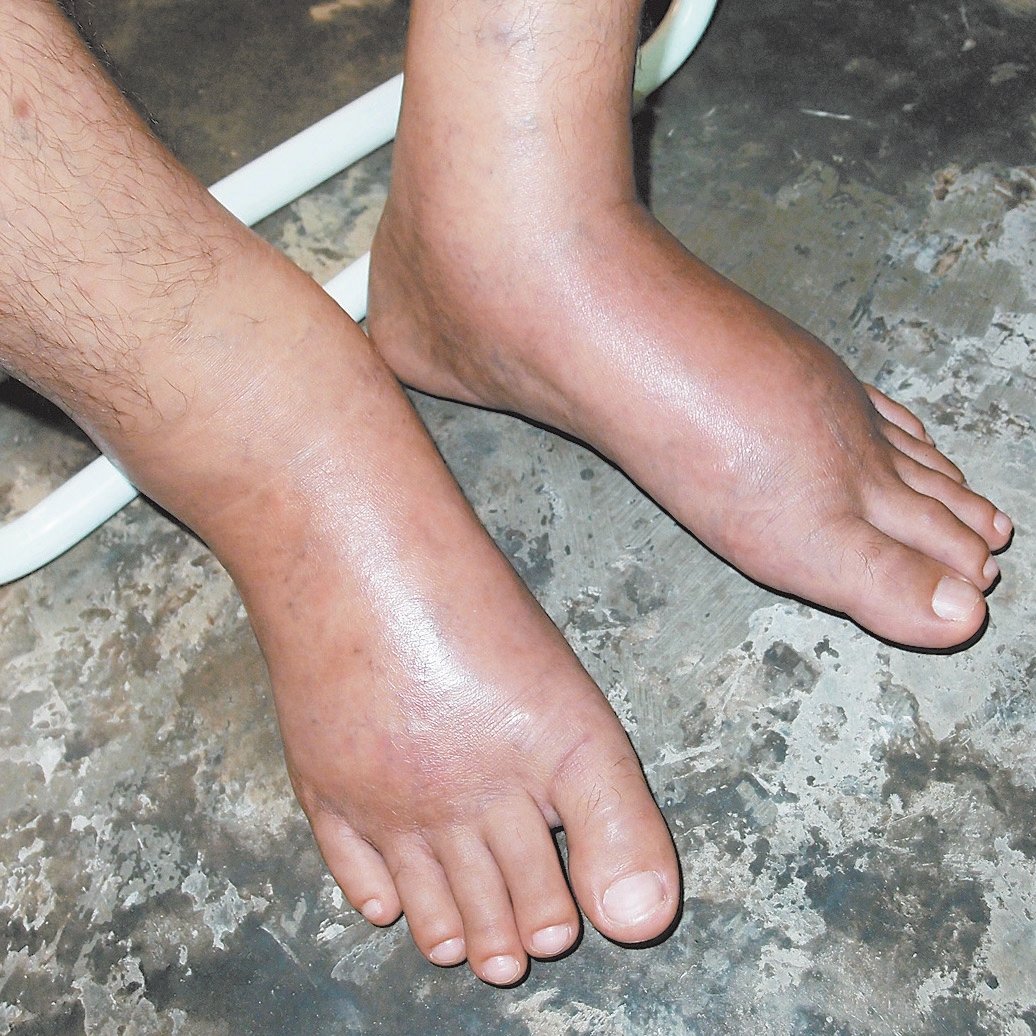 尽管脚肿已一个多月，黄守泉为省治疗费，只好等到复诊时再给医生检查。