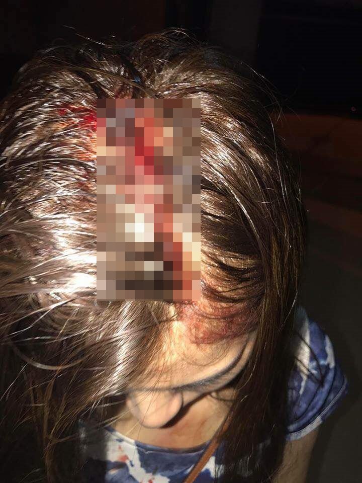 女网民声称遭餐馆老板打爆头，并在面子书上载受伤的照片。