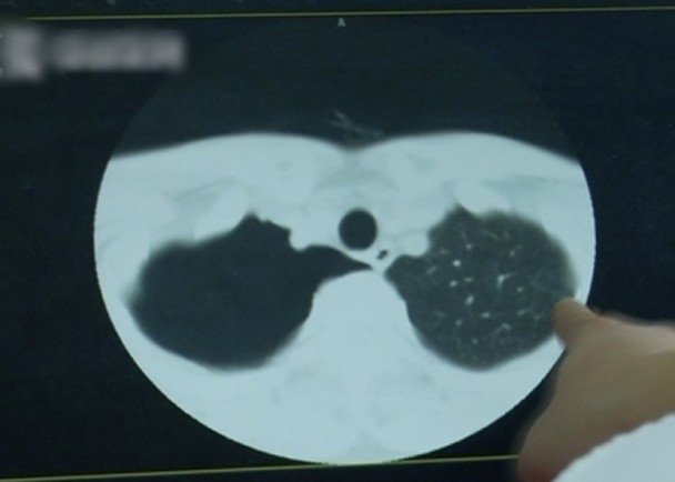 医生发现男子右肺被压缩了90%。