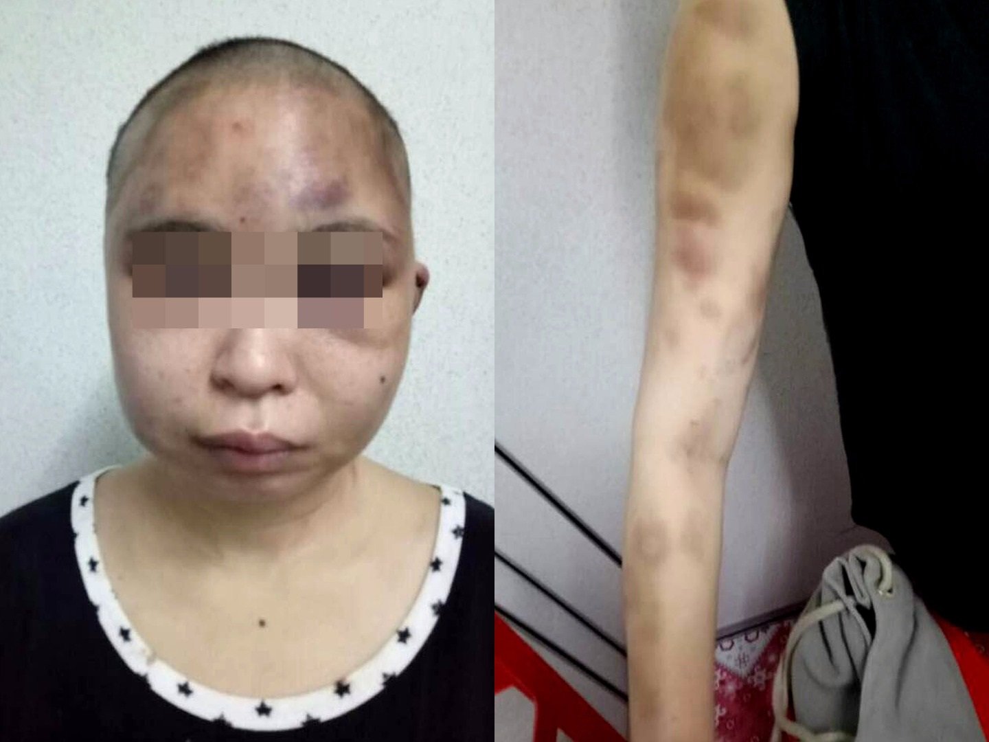 华裔男子怀疑妻子外遇，愤而剔光妻子的头发，对她施暴，以致她满脸瘀青。照片由警方提供