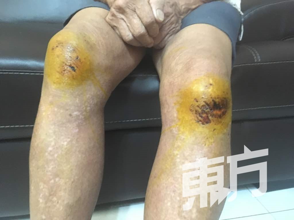 陈氏老翁的双脚膝盖擦伤。