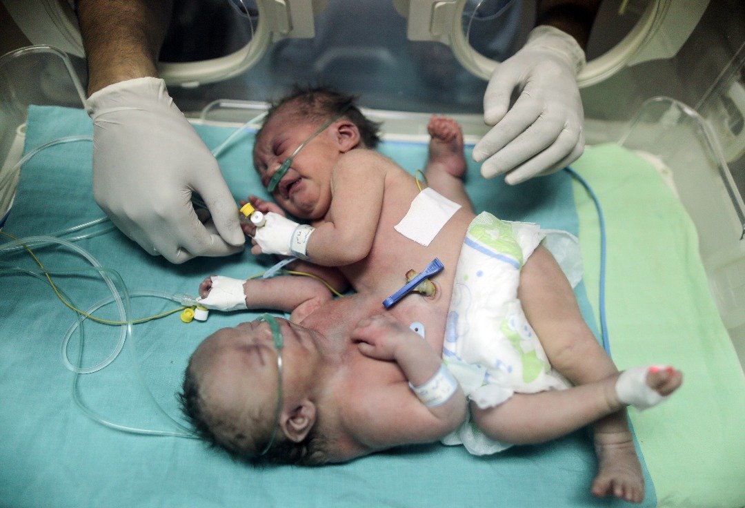 以色列封锁的加沙地带，有一对连体婴急需离开当地，到外国接受分割手术。-法新社-