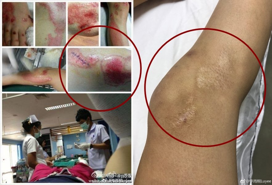 左为薛之谦曾经微博发出的受伤拼图；右为李雨桐让网友对照的伤痕。