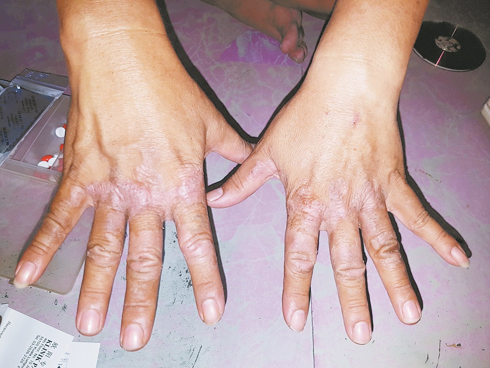 陆松耀的手部因为长期接触化学药物， 而变成黑色，偶尔会发痒，无法工作。