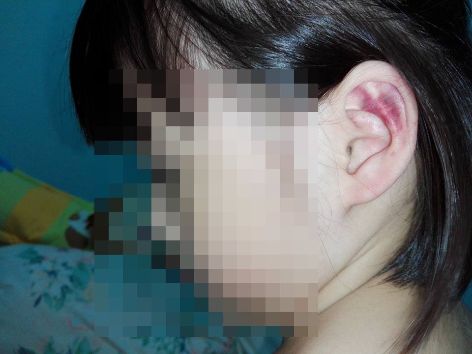 傅培育控诉幼稚园华裔女老师捏其女儿的耳朵，导致瘀血。