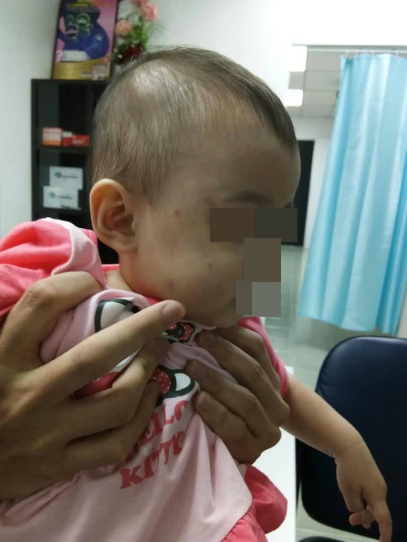女婴的脸颊红肿处，保姆称是被蚊子叮咬所致。