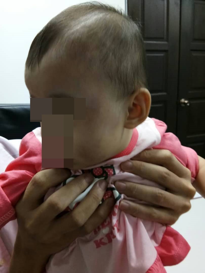 女婴的脸部，出现疑是被掌掴的手指印痕迹。