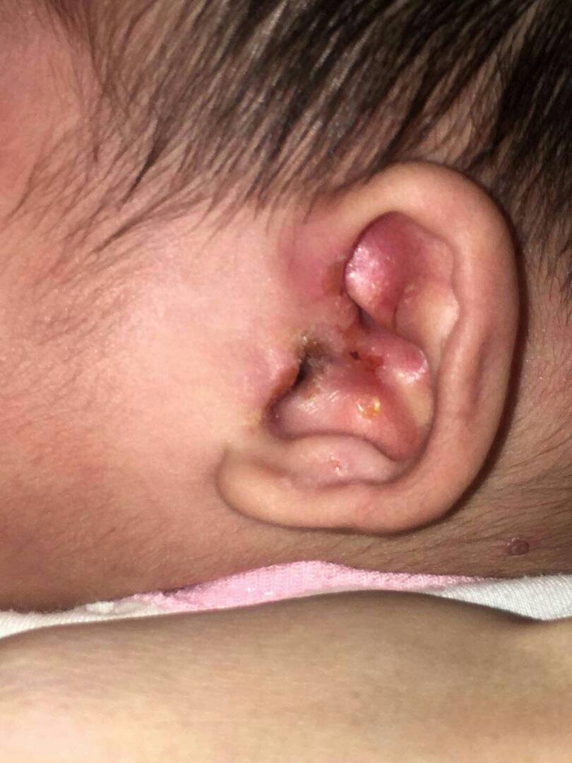 事主指其儿子的耳朵被人为弄伤，之后伤口还因细菌感染而红肿生脓。
