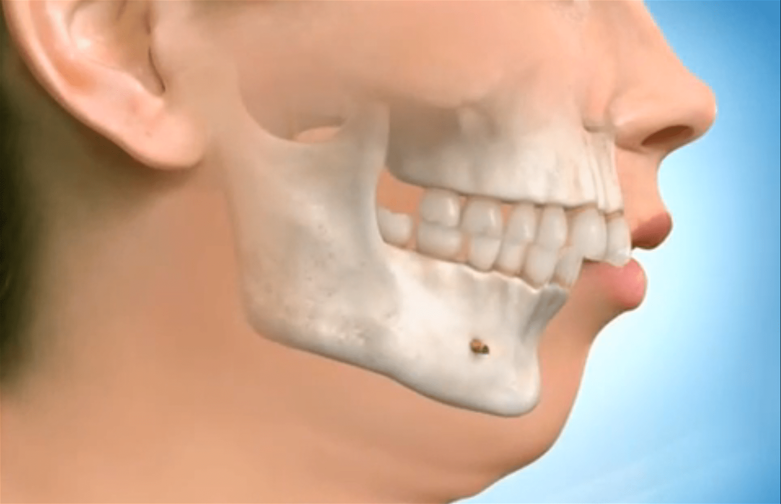 上颌骨头突出，俗称龅牙；也是露龈笑的原因之一。