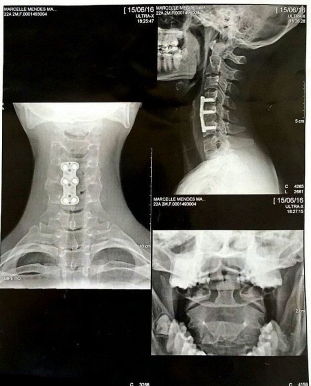 曼库索的X光照显示颈椎断裂和移位。