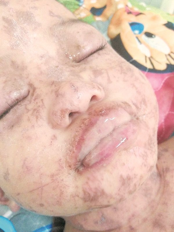 诺爱莎因遭到蚊虫和蚂蚁叮咬，导致其脸部及嘴唇出现红肿及出脓的现象。图：取自诺法蒂拉面子书