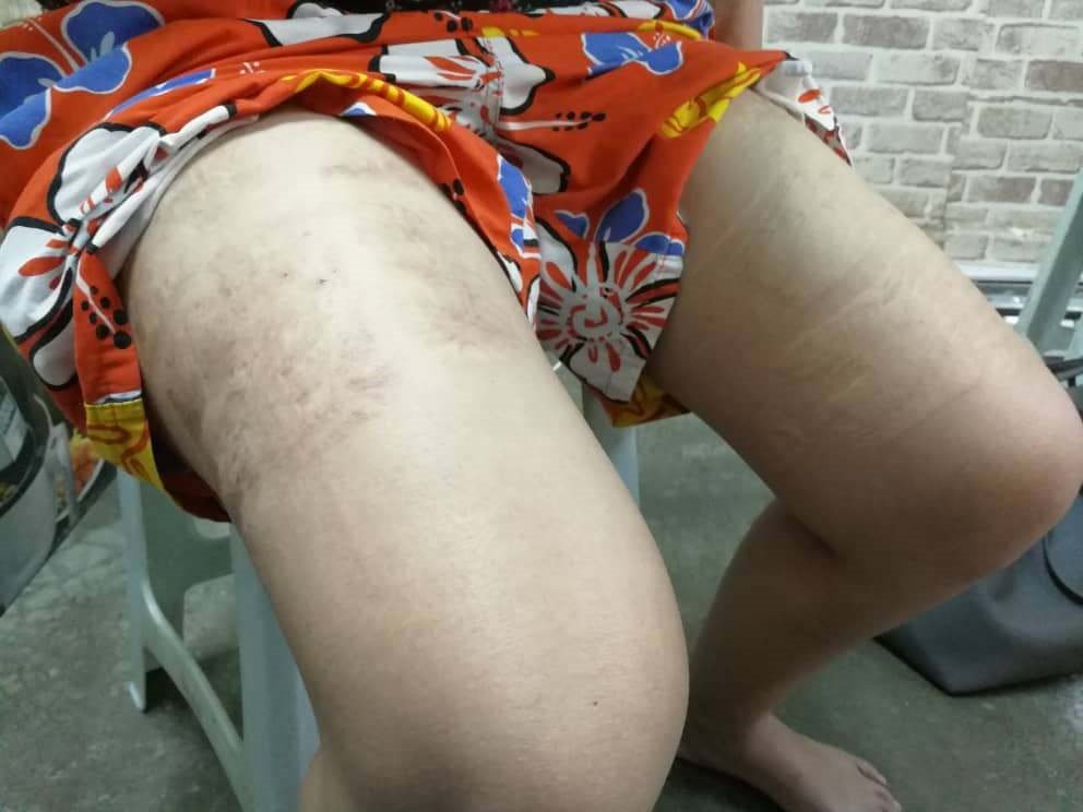 涂小芳的双腿留有植皮后的疤痕。