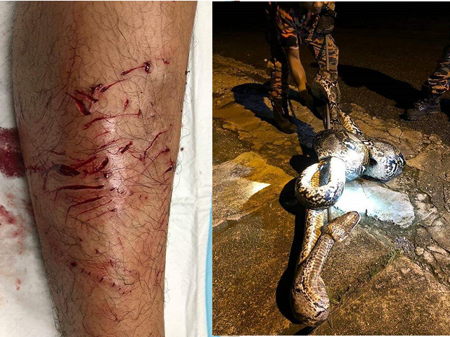 男子的腿部满是蟒蛇的咬痕。