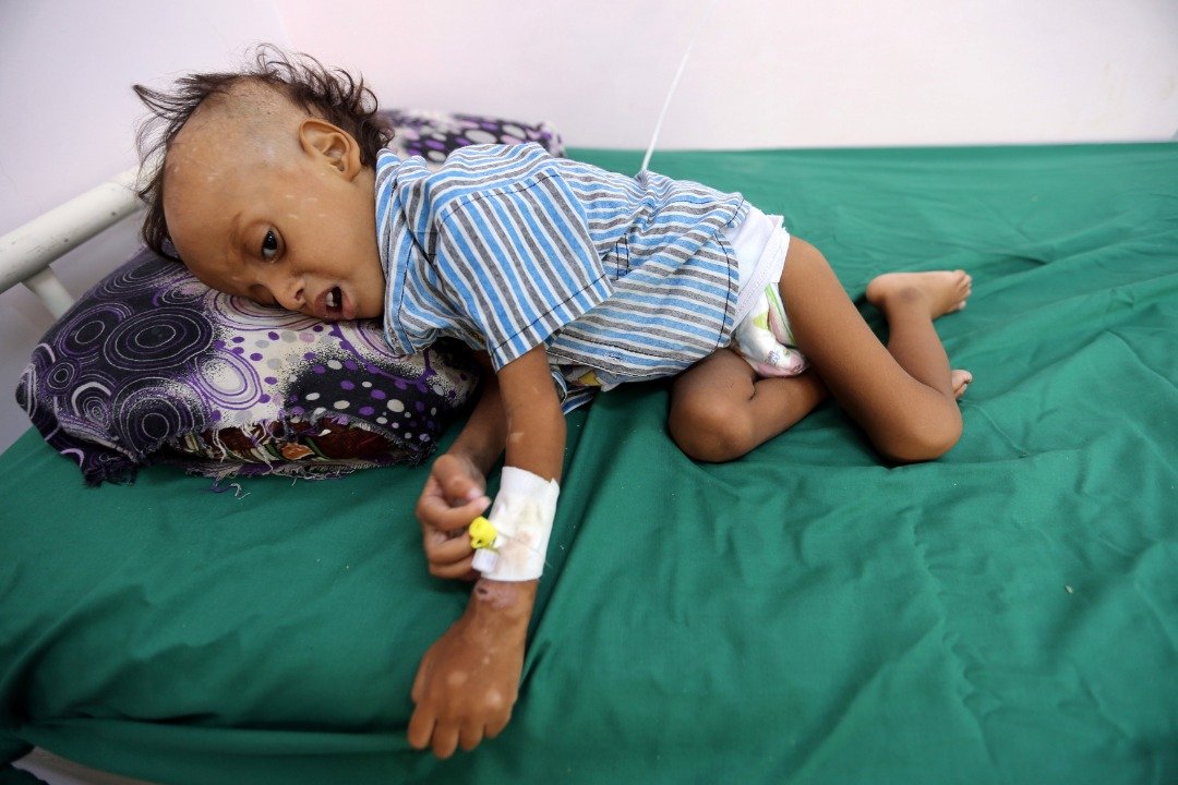只有2岁的哈卡米，躺在荷台达省一间医院的病床上，接受营养不良的治疗。联合国儿童基金会指出，也门如今有180万名5岁以下的儿童，面临急性营养不良。