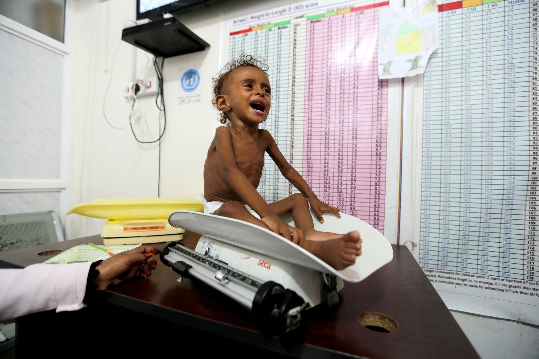 营养不良的2岁女童伊莱亚斯，在医院的磅秤重器上测量体重时，害怕得哭了起来。其胸前的肋骨清晰可见。