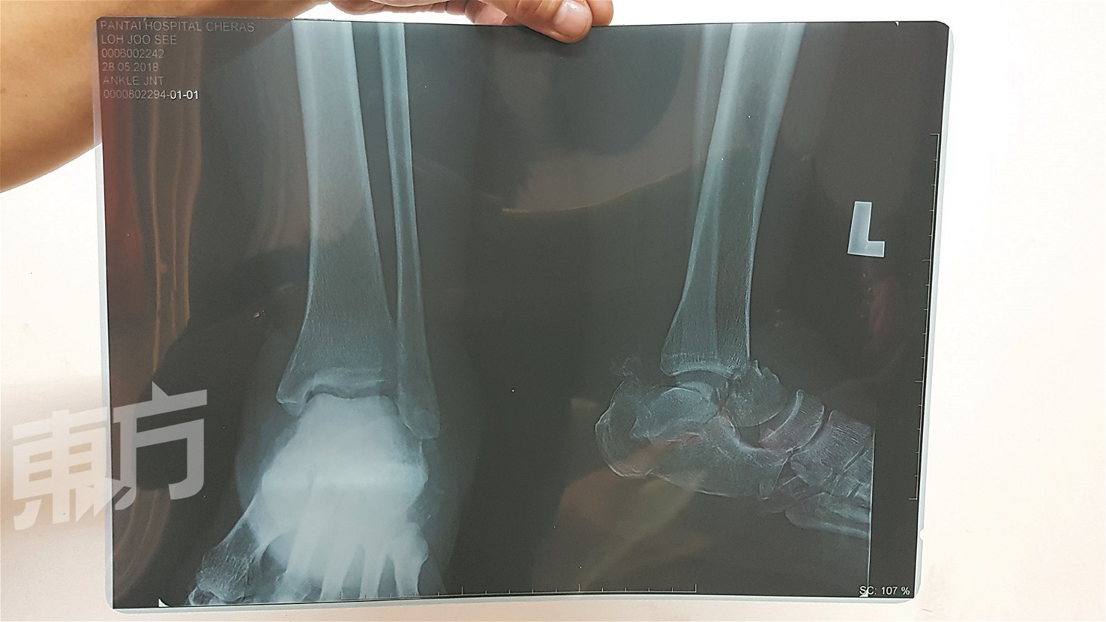 罗佑丝从楼梯跌下后，虽然没有感觉到疼痛，但照X光后才知道脚后的骨头已断裂，如今她只能靠撑拐杖走路。（摄影：田咏逸）
