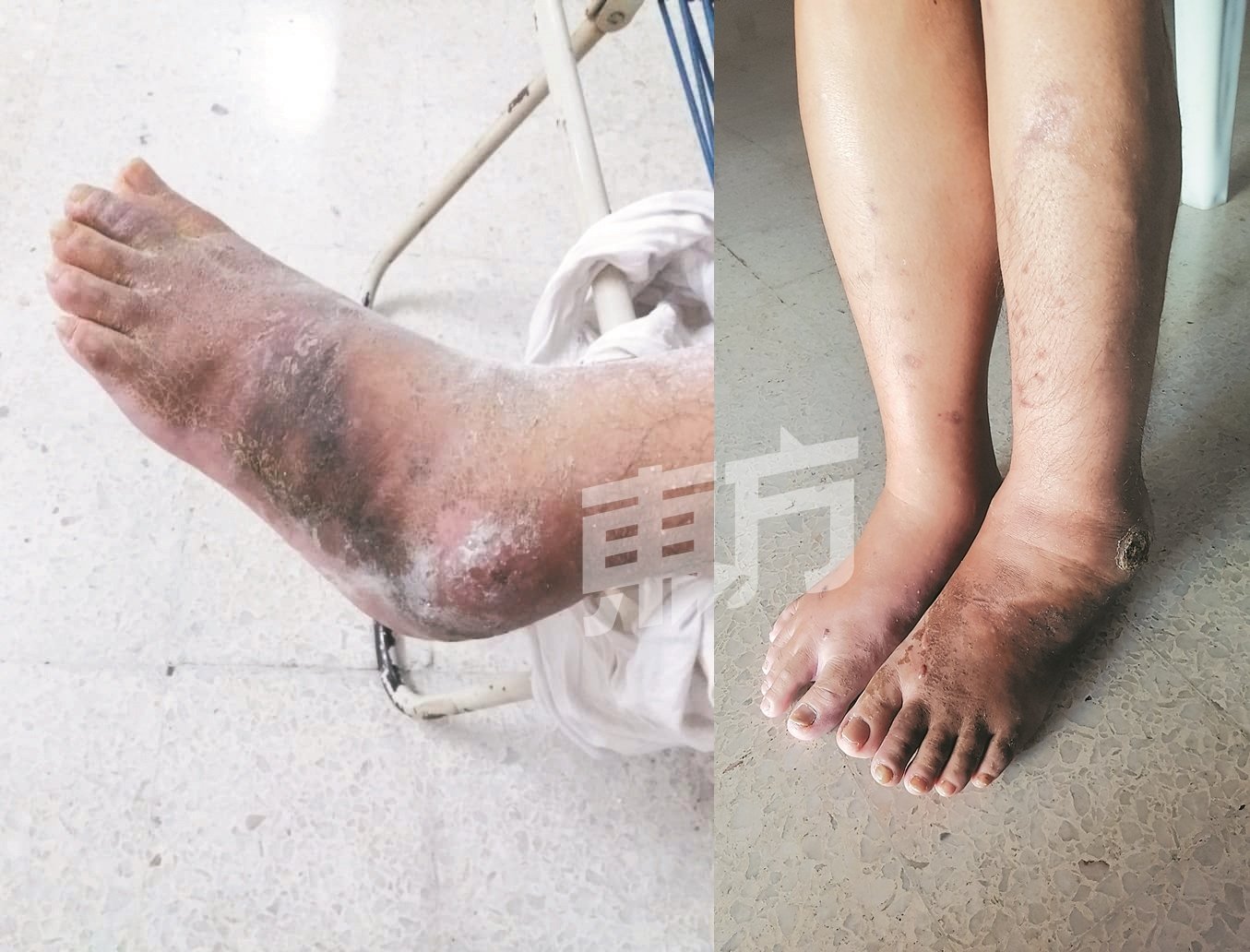 由于患有轻微糖尿病，罗佑丝包石膏后伤口恶化（左）。经过中医师治疗，罗佑丝的脚已有好转（右），然而却负担不起医费。（摄影：田咏逸）