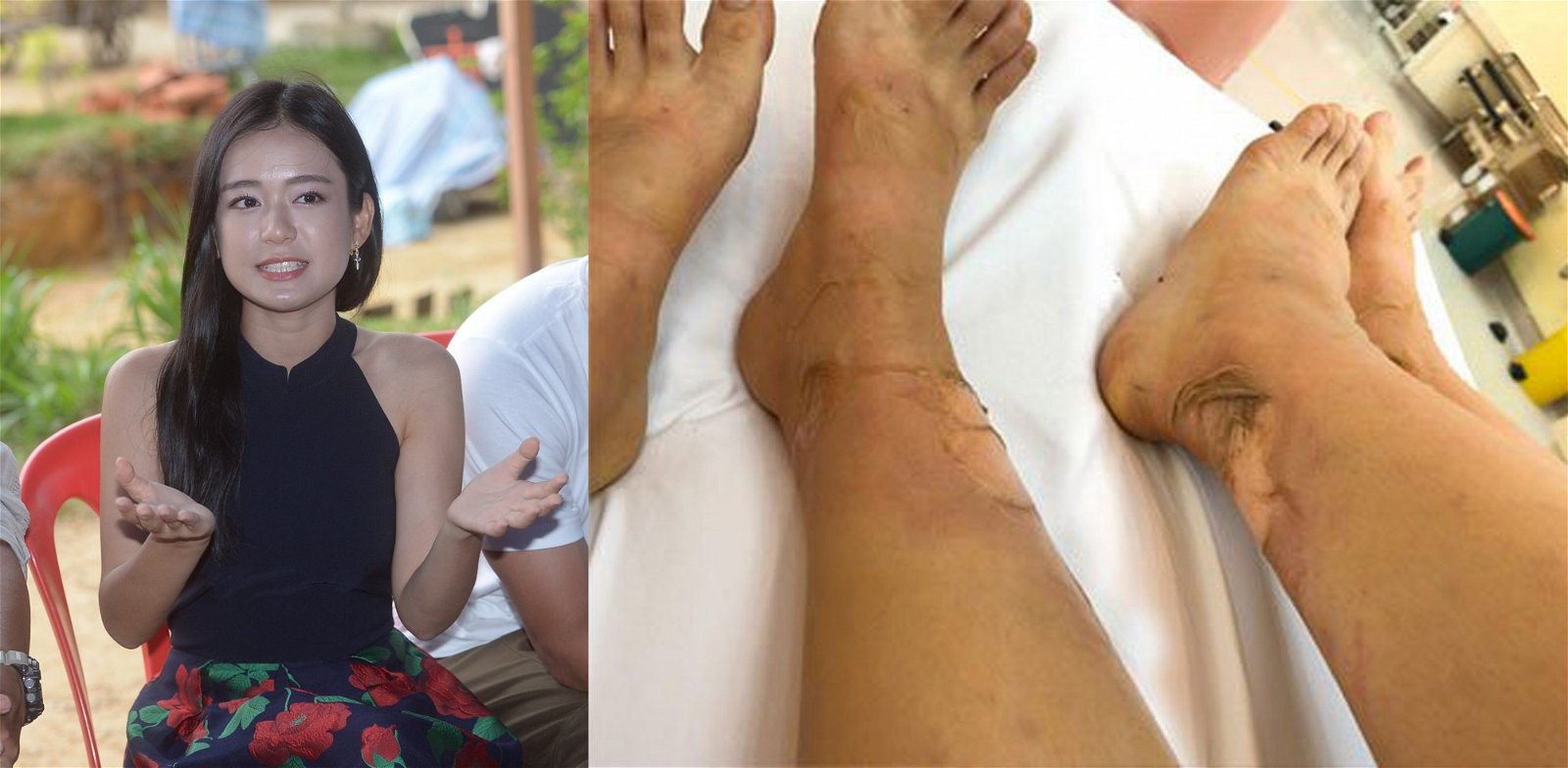 本地著名艺人梁祖仪，双腿在火灾中不幸被烧伤。