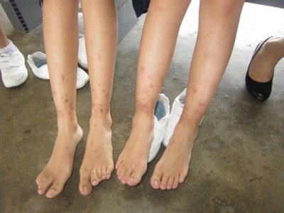 2名学生小腿被不知名昆虫叮咬后，出现水泡和红斑。