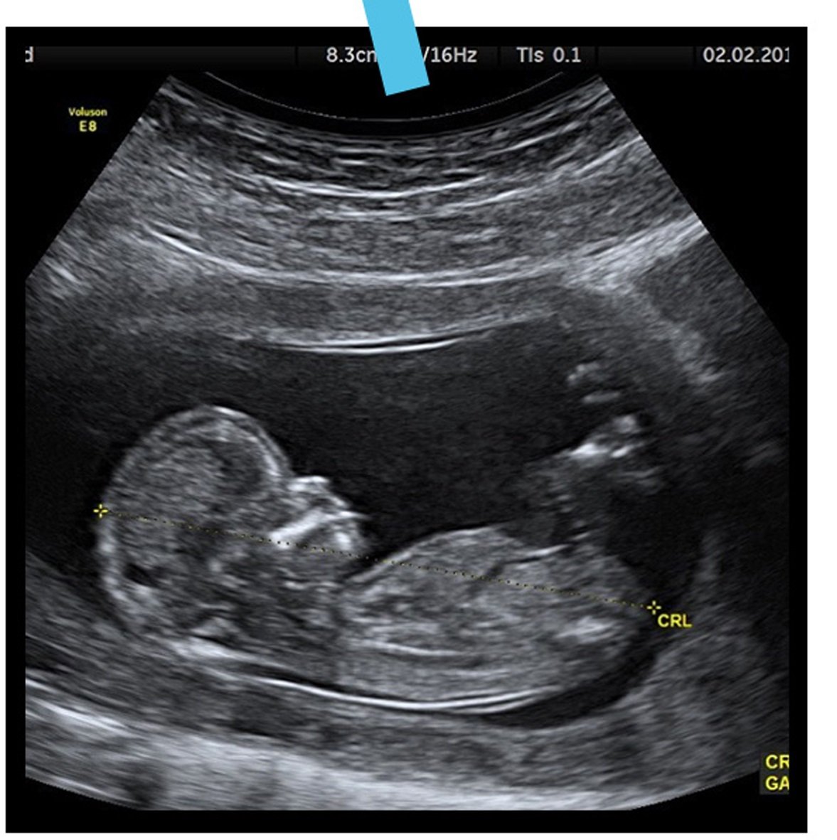 贾斯汀上传了一张很像超声波的照片，造成妻子海莉怀孕的谣言。