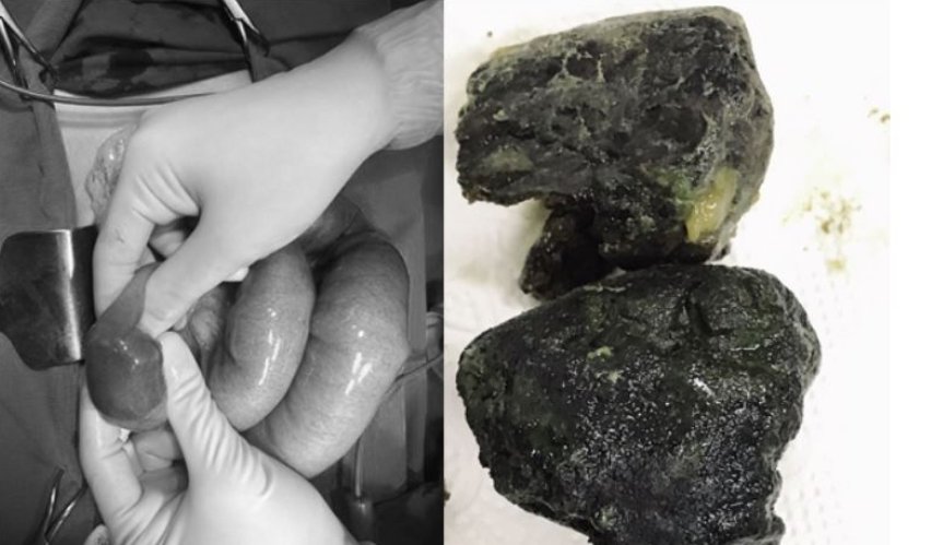 医生从男子肠胃取出2大块像黑矿石的珍珠块。