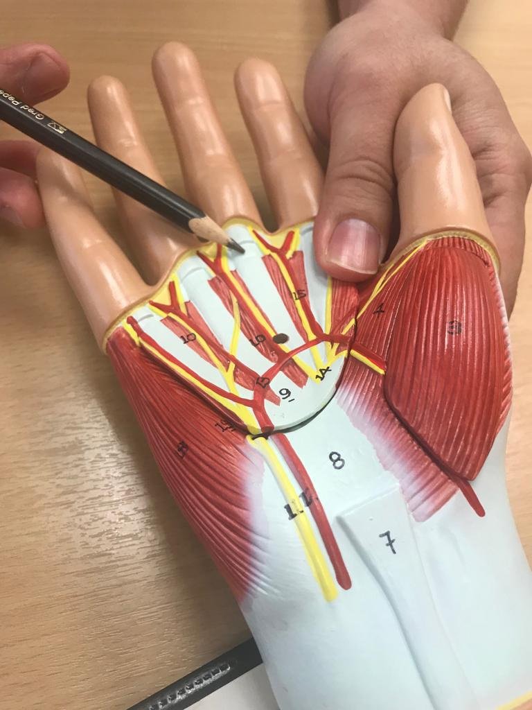 郑国钦指出，微创手术是于弹弓指下方的掌心开约1公分的口，剪开腱鞘，使肿胀的肌腱能滑动就能解决弹弓指的问题。