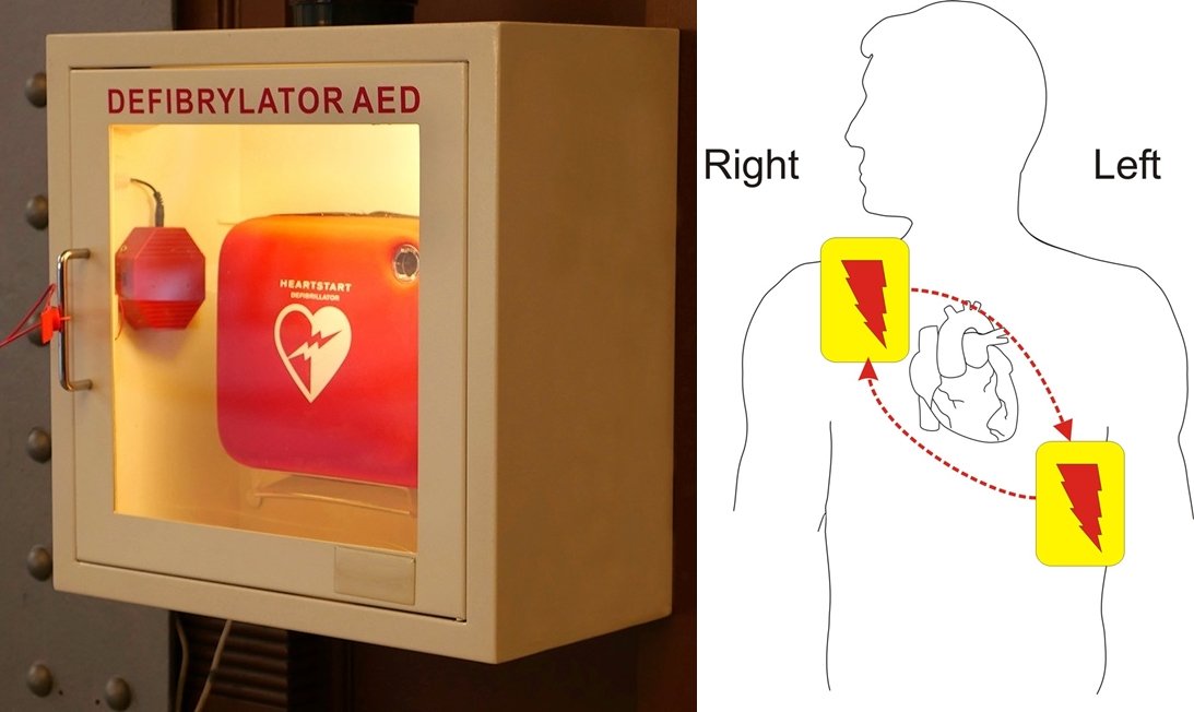 AED电击贴片应贴在病患身体位置（如图），在进行分析及电击时，切勿触碰患者。