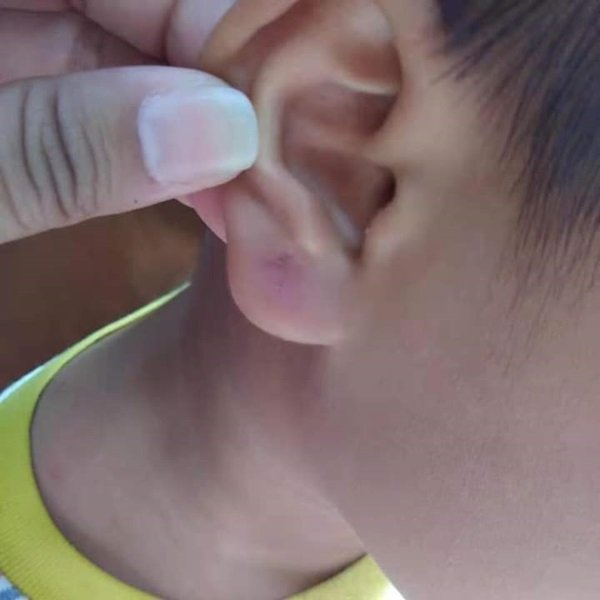 家长不满老师拉扯其孩子的耳朵至红肿脱皮。