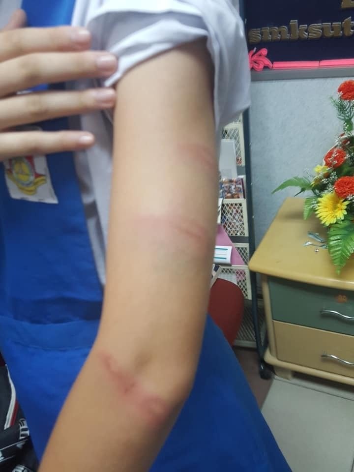 女学生手臂及大腿，均出现遭鞭打的伤痕。