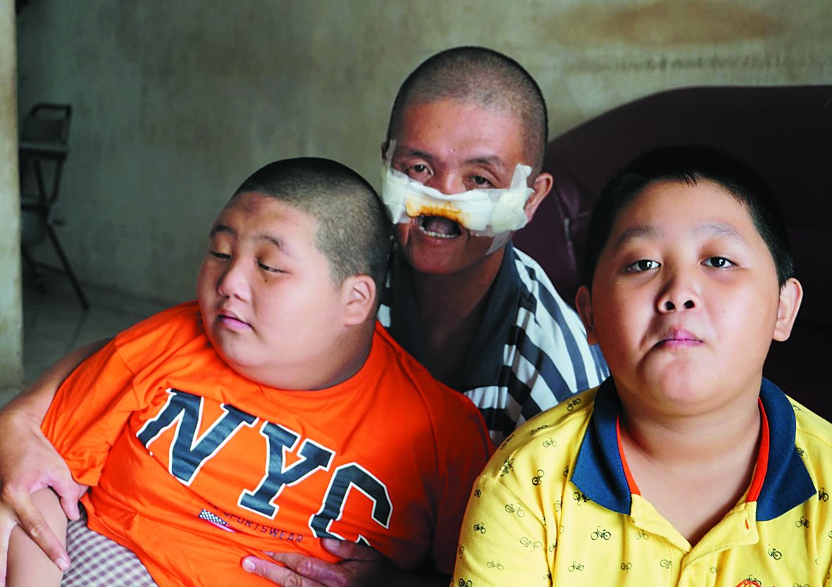 林伟彬（左）和林伟鑫（右）希望，父亲林建达可以早日进行鼻唇整形手术。