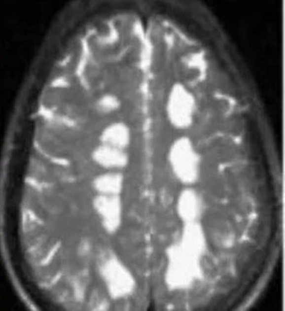 医生为男子做头颅磁共振后，发现其两侧大脑半球已多发病变。（图取自互联网）