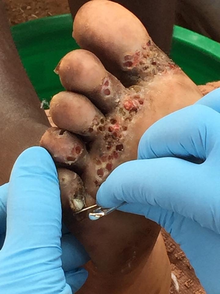 医护人员正为患者将沙蚤的卵从脚底取出，该过程是十分痛苦的。