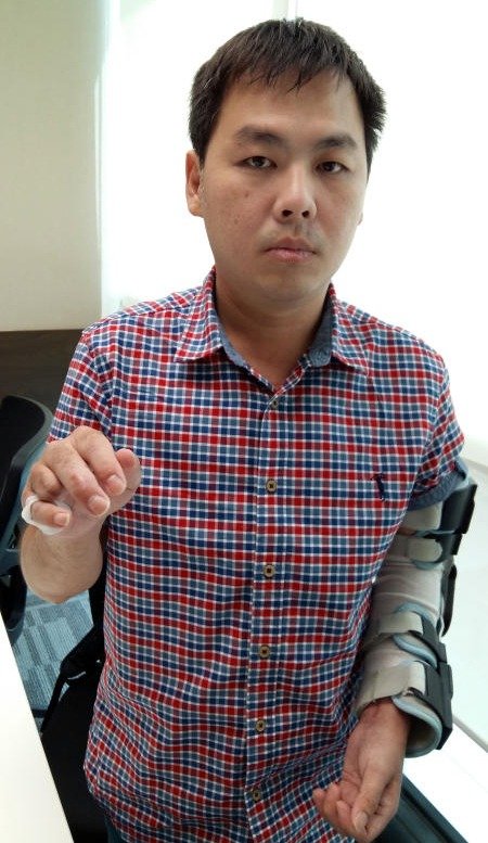 郑子洋的右手无名指在车祸后断落。（档案照）