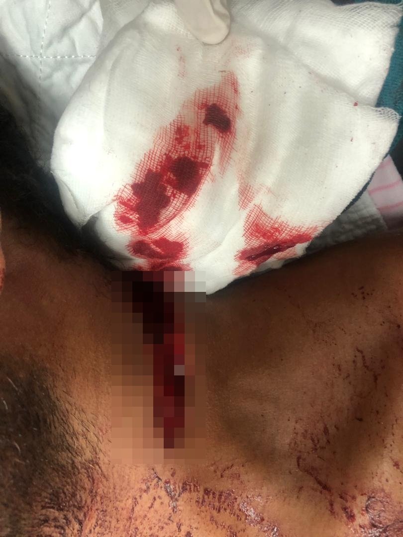 斯里兰卡男子的颈项被割伤后，出现一道很深的伤口。