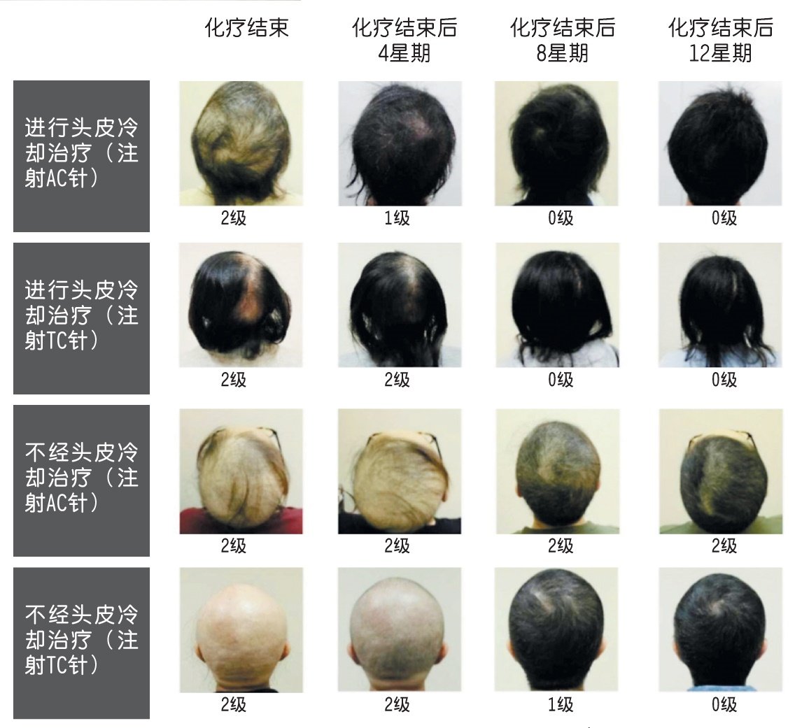 接受头皮冷却治疗的病患比其他患者少脱发，在治疗结束后，生发的速度也明显较快且浓密。