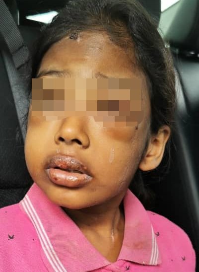 女童疑被继母虐打，眼睛瘀肿、额头也有伤痕。
