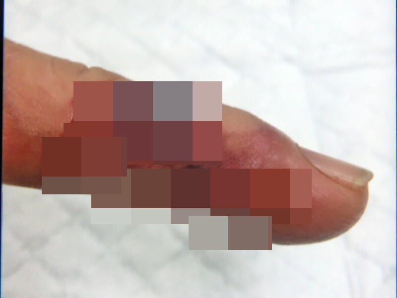 陳先生洗蝦時被刺傷，手指變黑變腫。
