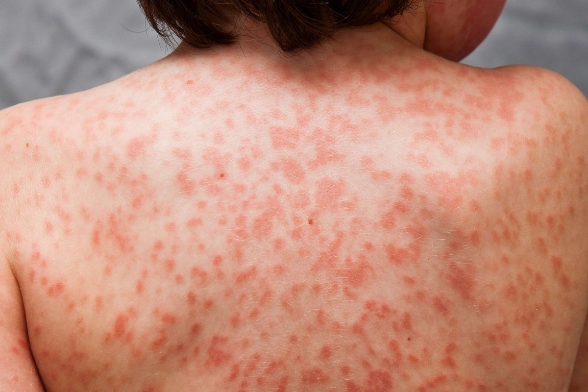 罹患川崎症的儿童，身体会出现红疹。