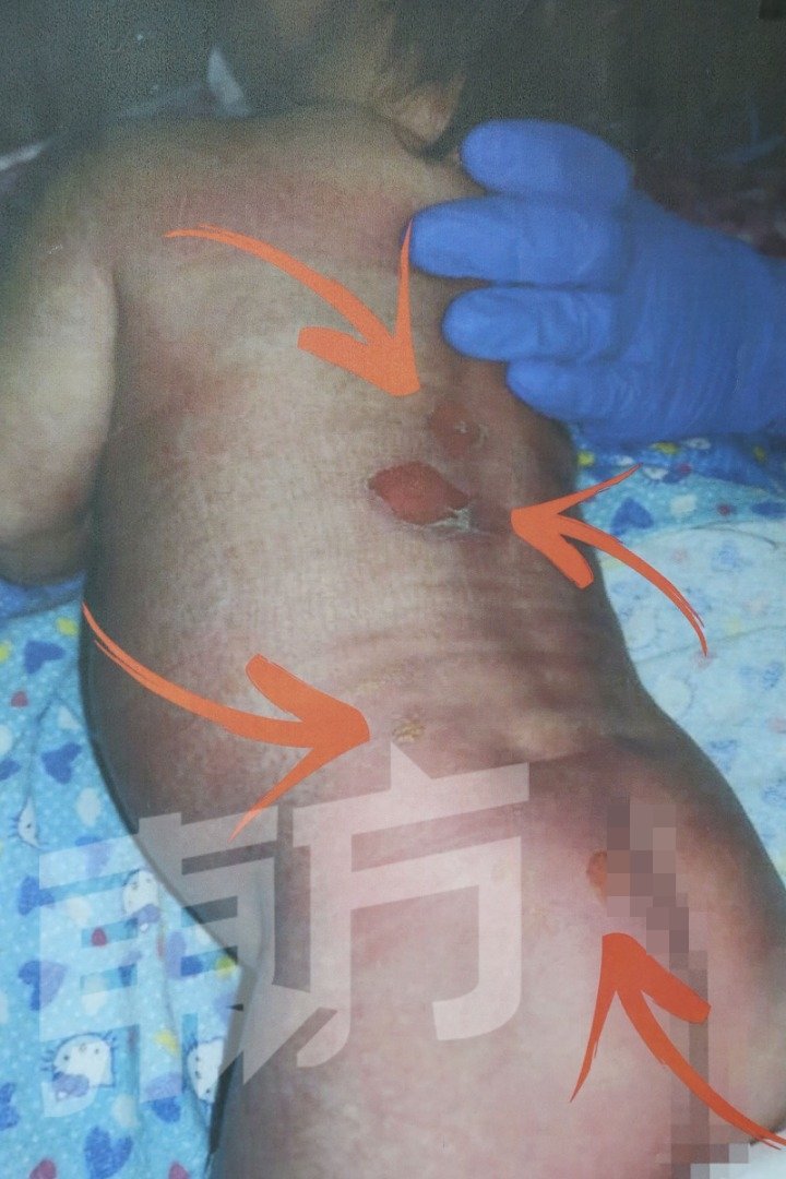男婴遭热水烫伤背部和臀部。