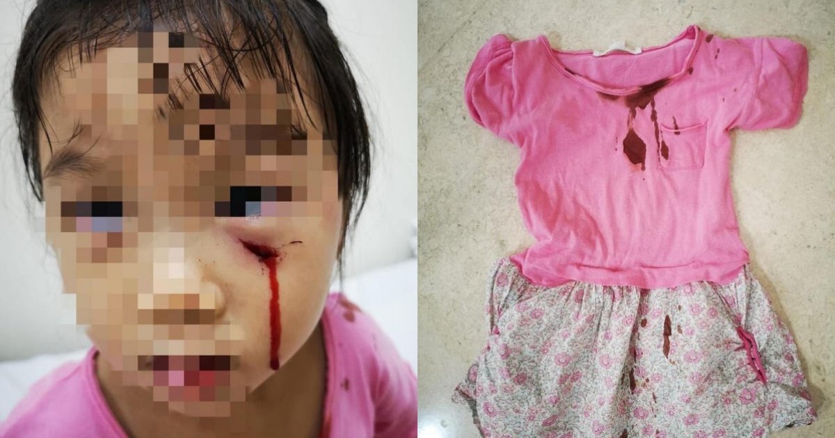 女童被孔雀袭击，脸出现3公分伤口，衣服也沾满血迹。（受访者提供）